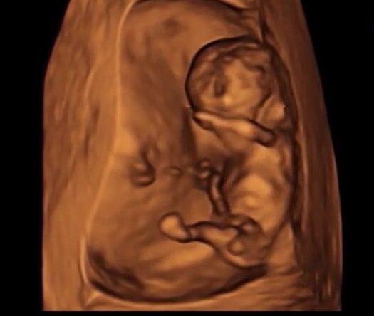 R先生の性別判定10週6日｜ナブから7割男児と判断されたエコー画像