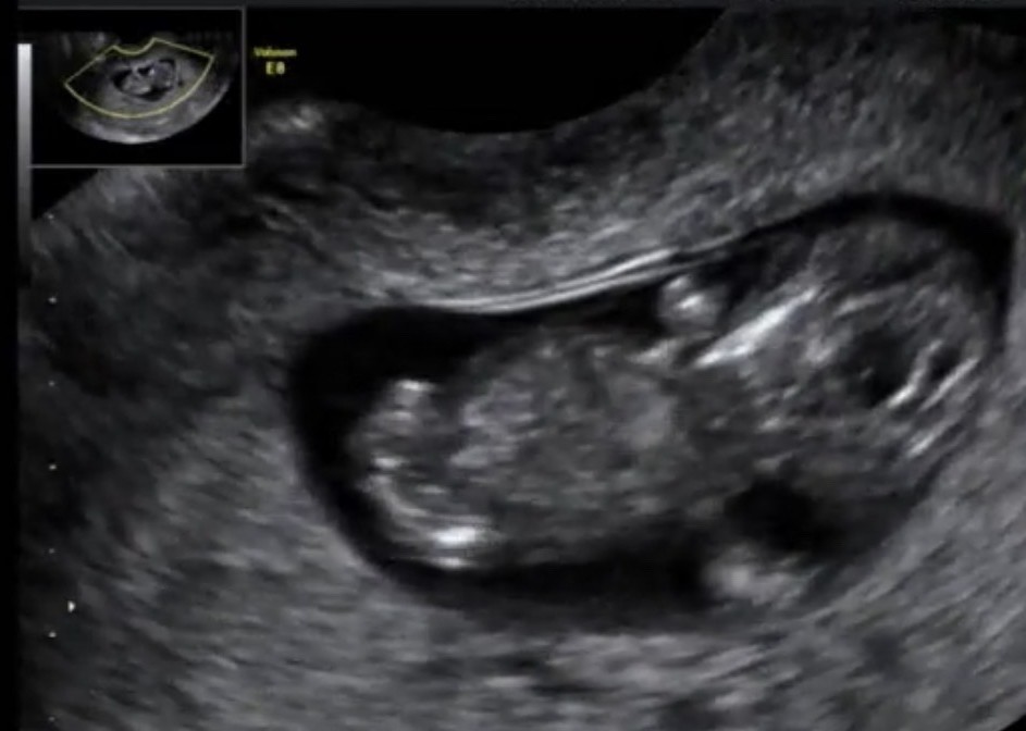 R先生の性別判定10週6日｜ナブから7割男児と判断されたエコー画像