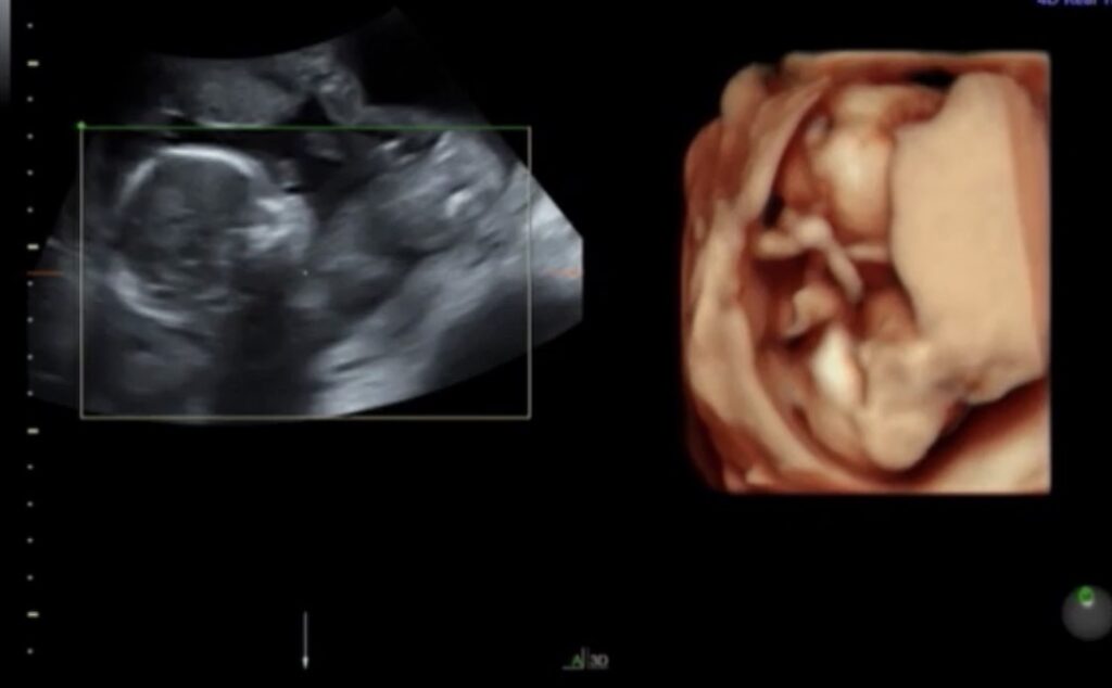 R先生の性別判定18週0日｜男児から女児に逆転したエコー画像