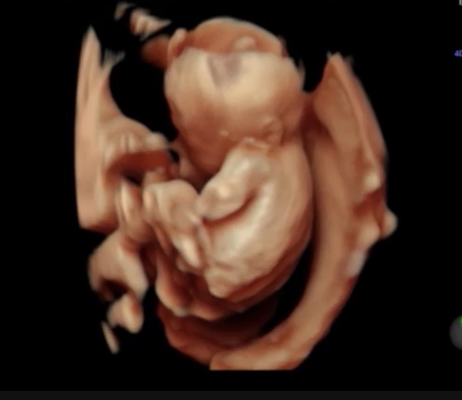 妊娠22週のエコー画像｜産院で女の子と確定した時の様子