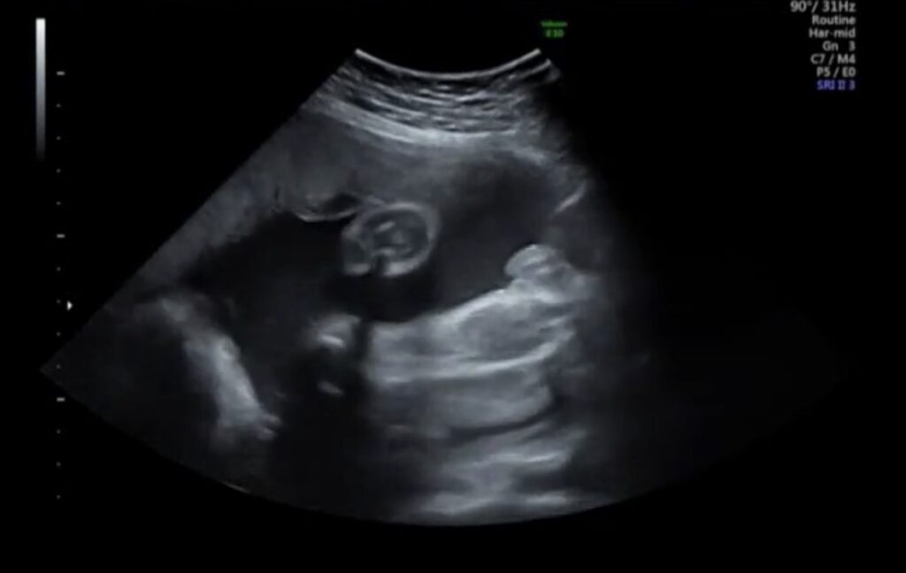 女児確定時のエコー画像｜性別がはっきり分かる部分